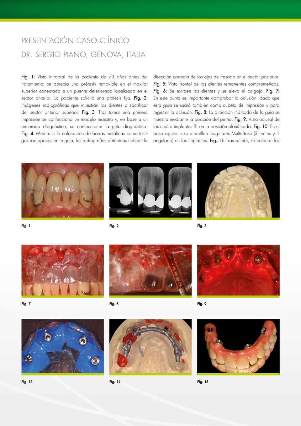 La paciente solicitó una prótesis fija. Fig. 2: Imágenes radiográficas que muestran los dientes a sacrificar del sector anterior superior. Fig. 3: Tras tomar una primera impresión se confecciona un modelo maestro y, en base a un encerado diagnóstico, se confeccionar la guía diagnóstica.