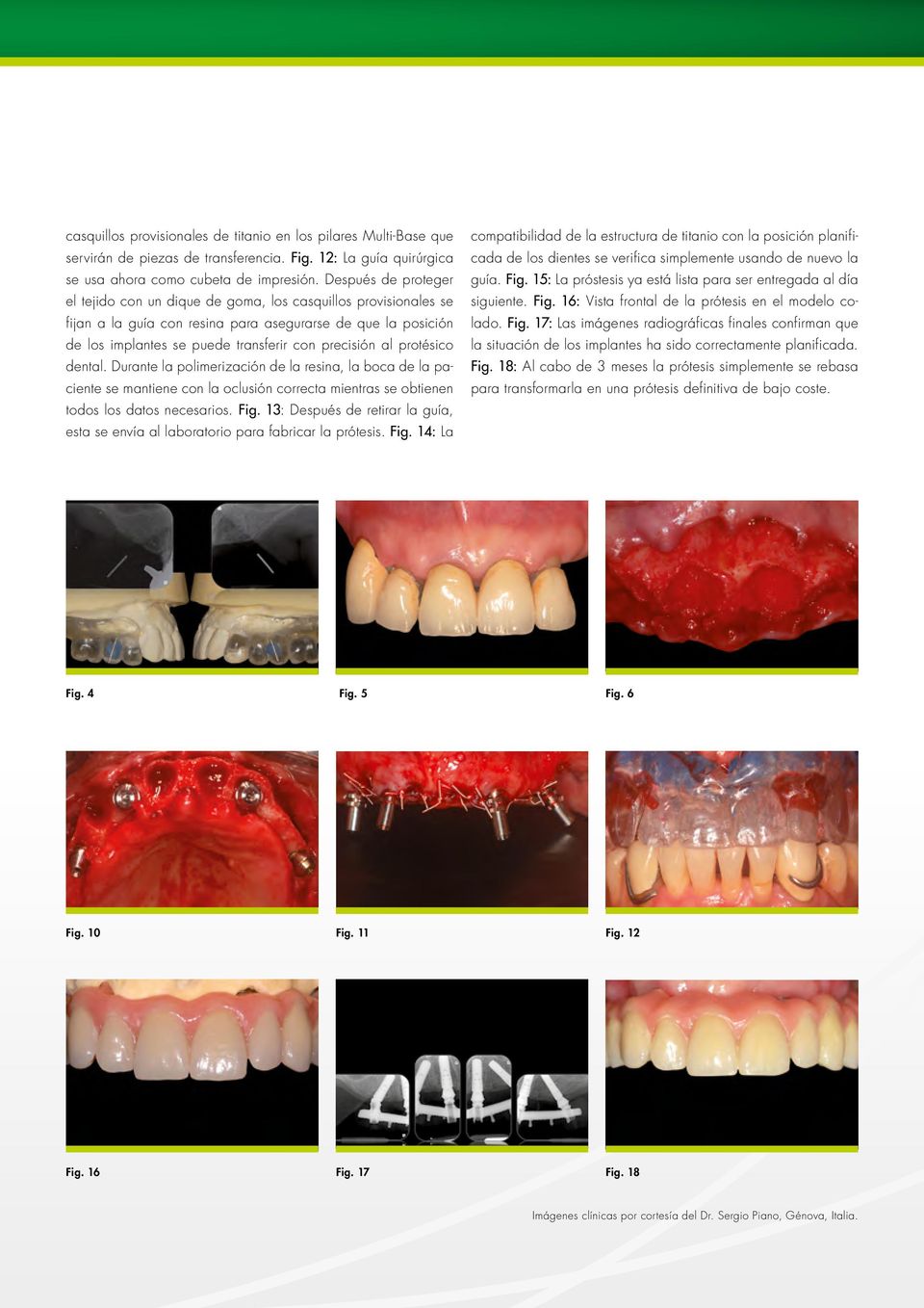 protésico dental. Durante la polimerización de la resina, la boca de la paciente se mantiene con la oclusión correcta mientras se obtienen todos los datos necesarios. Fig.