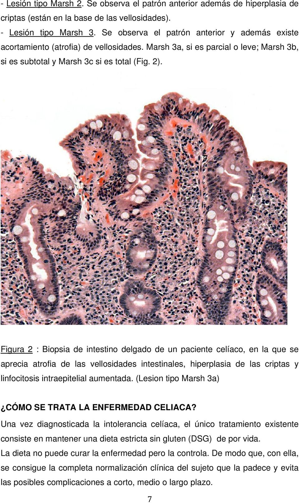 Figura 2 : Biopsia de intestino delgado de un paciente celíaco, en la que se aprecia atrofia de las vellosidades intestinales, hiperplasia de las criptas y linfocitosis intraepitelial aumentada.