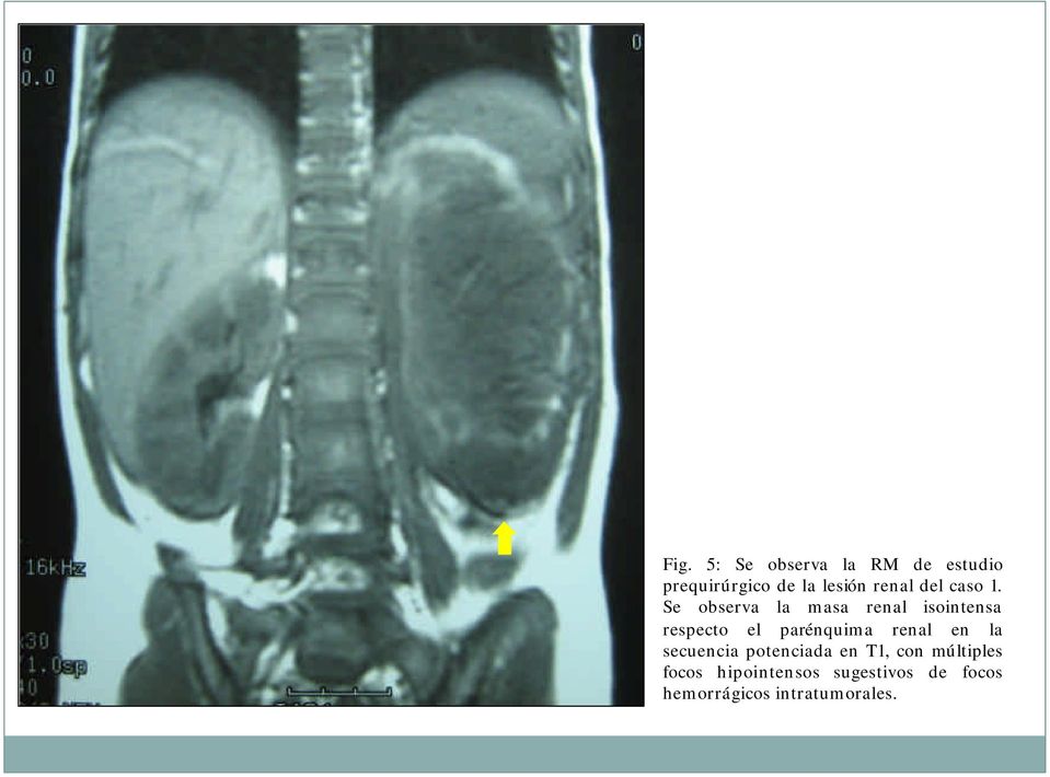 Se observa la masa renal isointensa respecto el parénquima renal