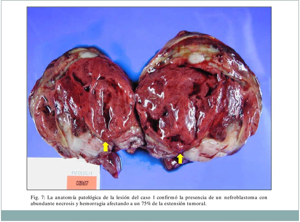 nefroblastoma con abundante necrosis y