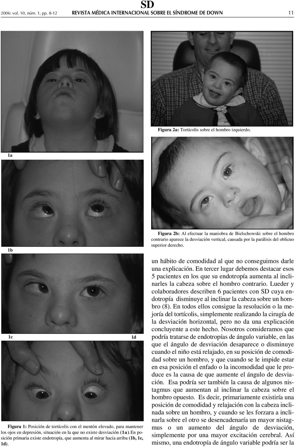 1b 1c 1d Figura 1: Posición de tortícolis con el mentón elevado, para mantener los ojos en depresión, situación en la que no existe desviación ( 1 a ).
