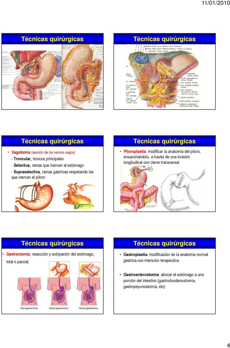 longitudinal con cierre transversal. Gastrectomía: resección y extirpación del estómago, total o parcial.