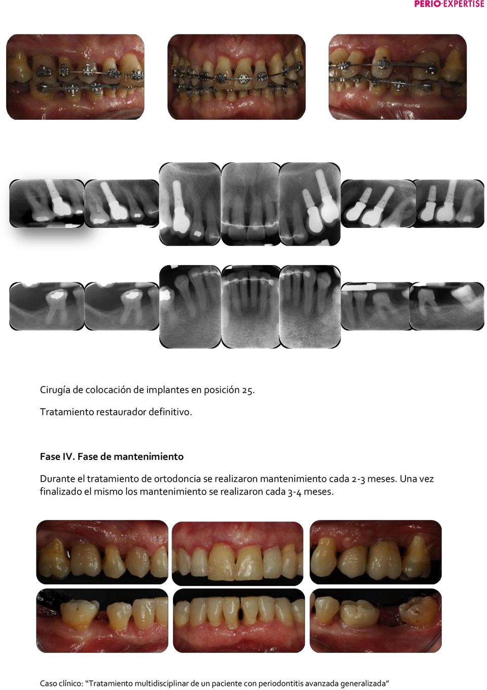Fase de mantenimiento Durante el tratamiento de ortodoncia se