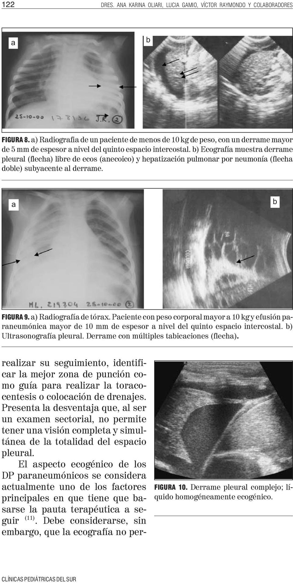 b) Ecografía muestra derrame pleural (flecha) libre de ecos (anecoico) y hepatización pulmonar por neumonía (flecha doble) subyacente al derrame. a b FIGURA 9. a) Radiografía de tórax.
