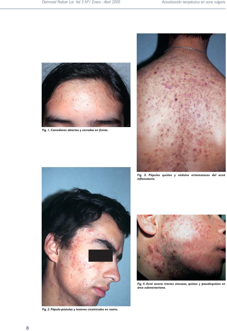 Pápulas quistes y nódulos eritematosos del acné inflamatorio. Fig. 4.