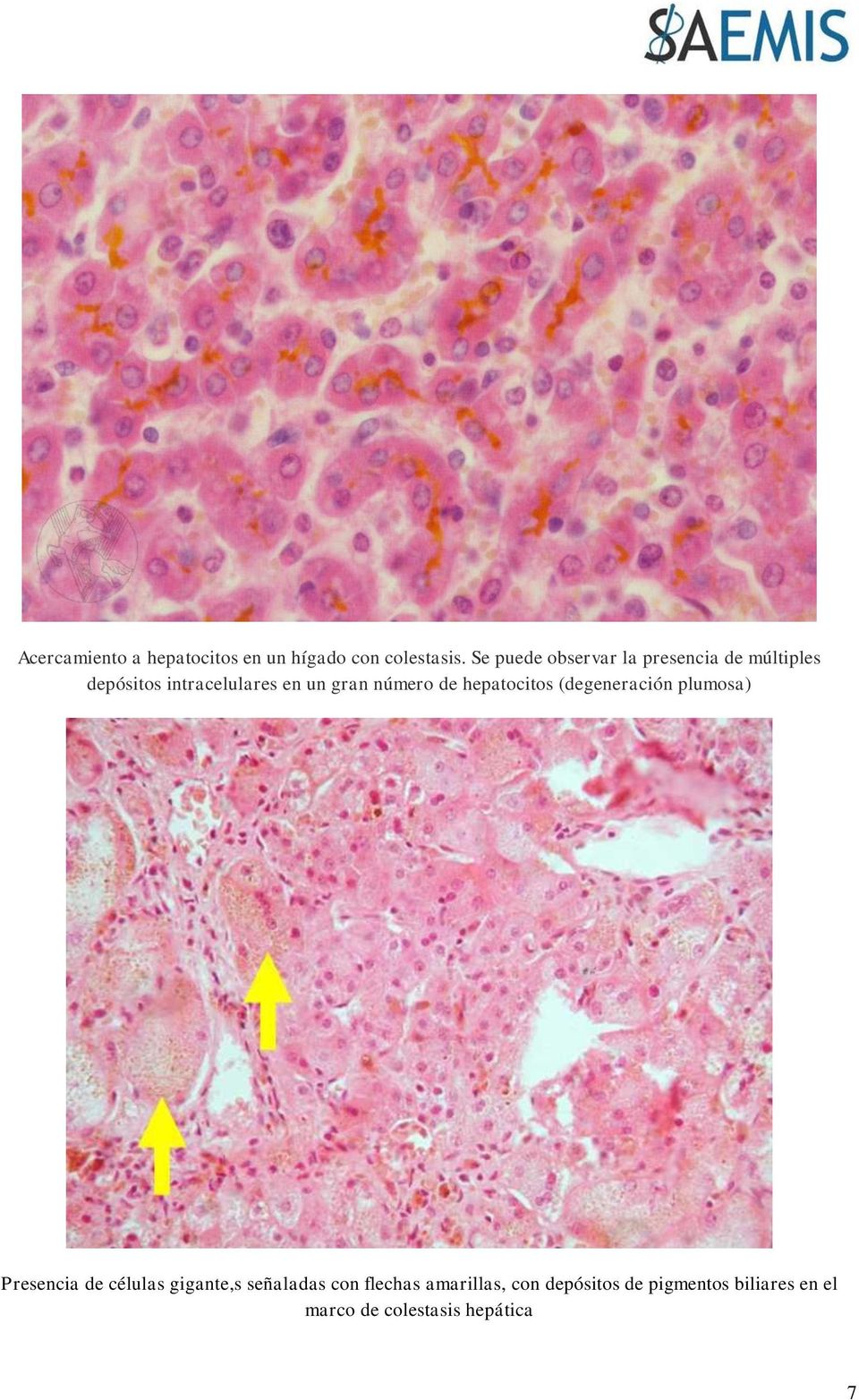 número de hepatocitos (degeneración plumosa) Presencia de células gigante,s