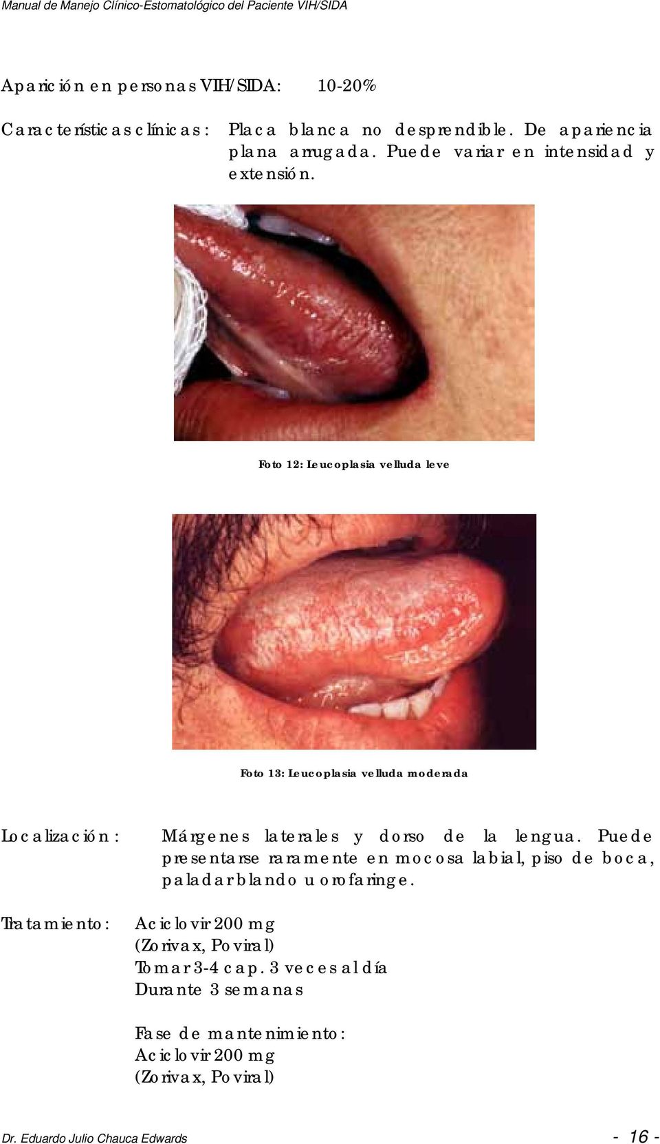 Foto 12: Leucoplasia velluda leve Foto 13: Leucoplasia velluda moderada Localización : Tratamiento: Márgenes laterales y dorso de la lengua.