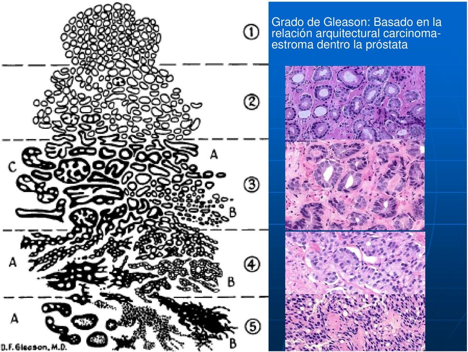 cáncer de próstata histología pdf