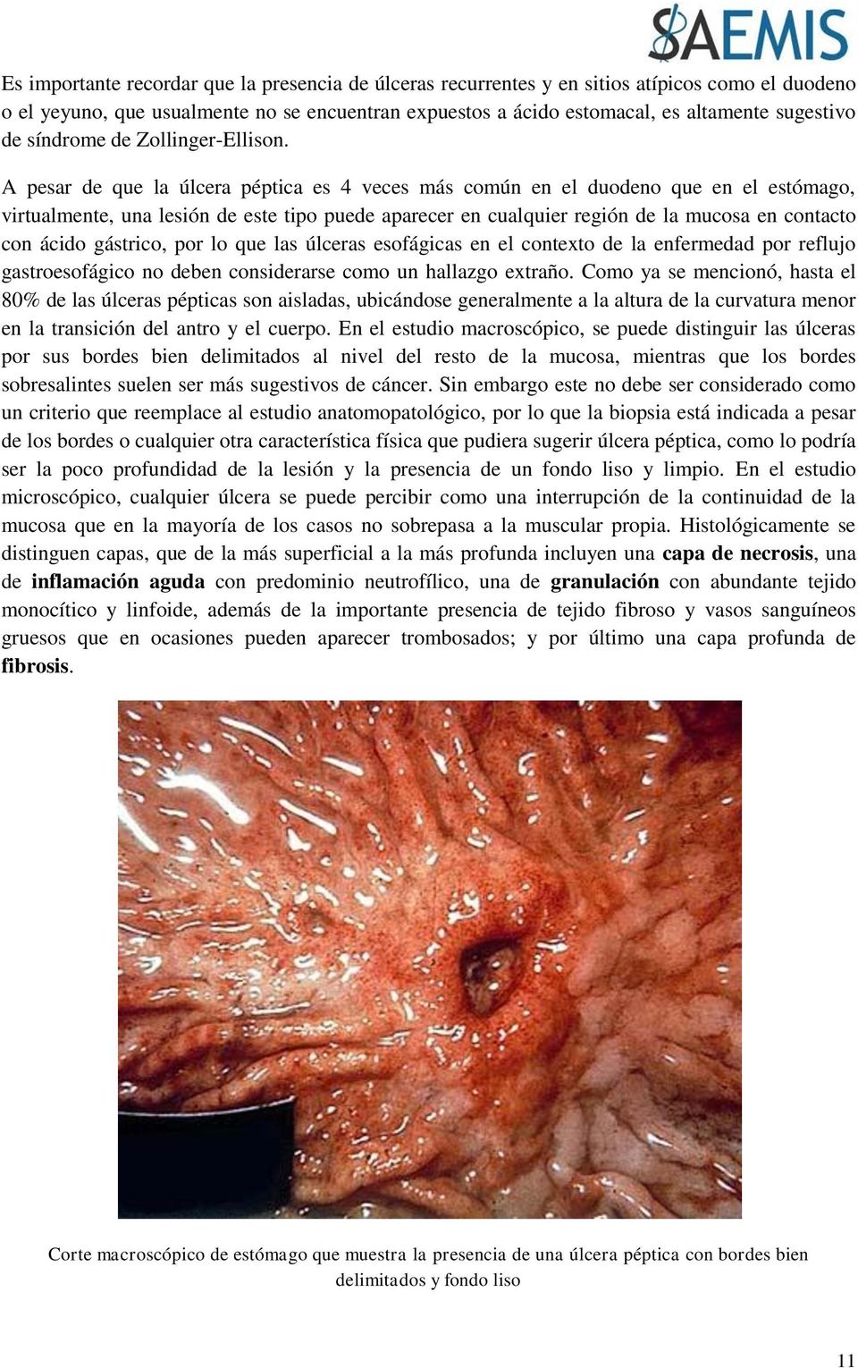 A pesar de que la úlcera péptica es 4 veces más común en el duodeno que en el estómago, virtualmente, una lesión de este tipo puede aparecer en cualquier región de la mucosa en contacto con ácido