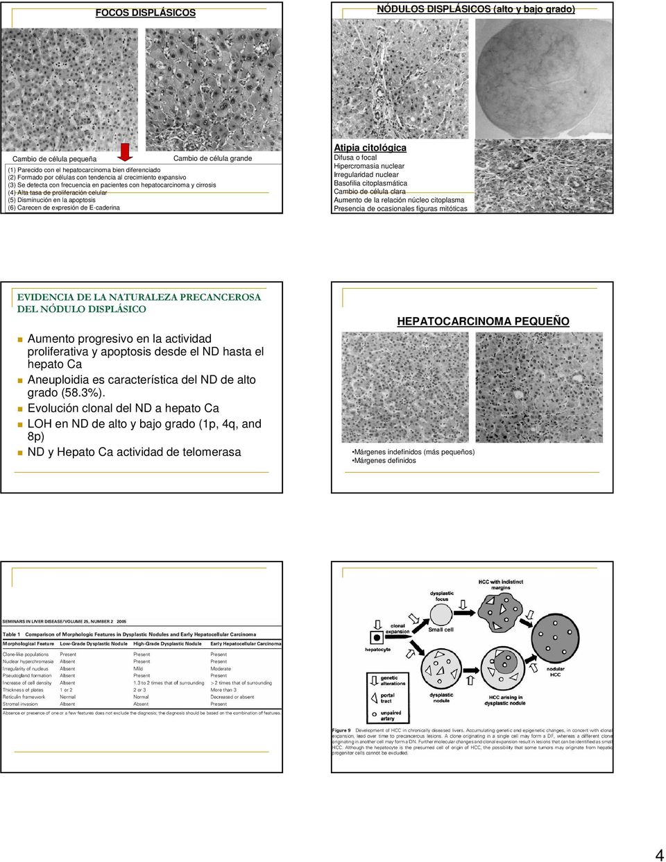 E-caderina Atipia citológica Difusa o focal Hipercromasia nuclear Irregularidad nuclear Basofilia citoplasmática Cambio de célula clara Aumento de la relación núcleo citoplasma Presencia de