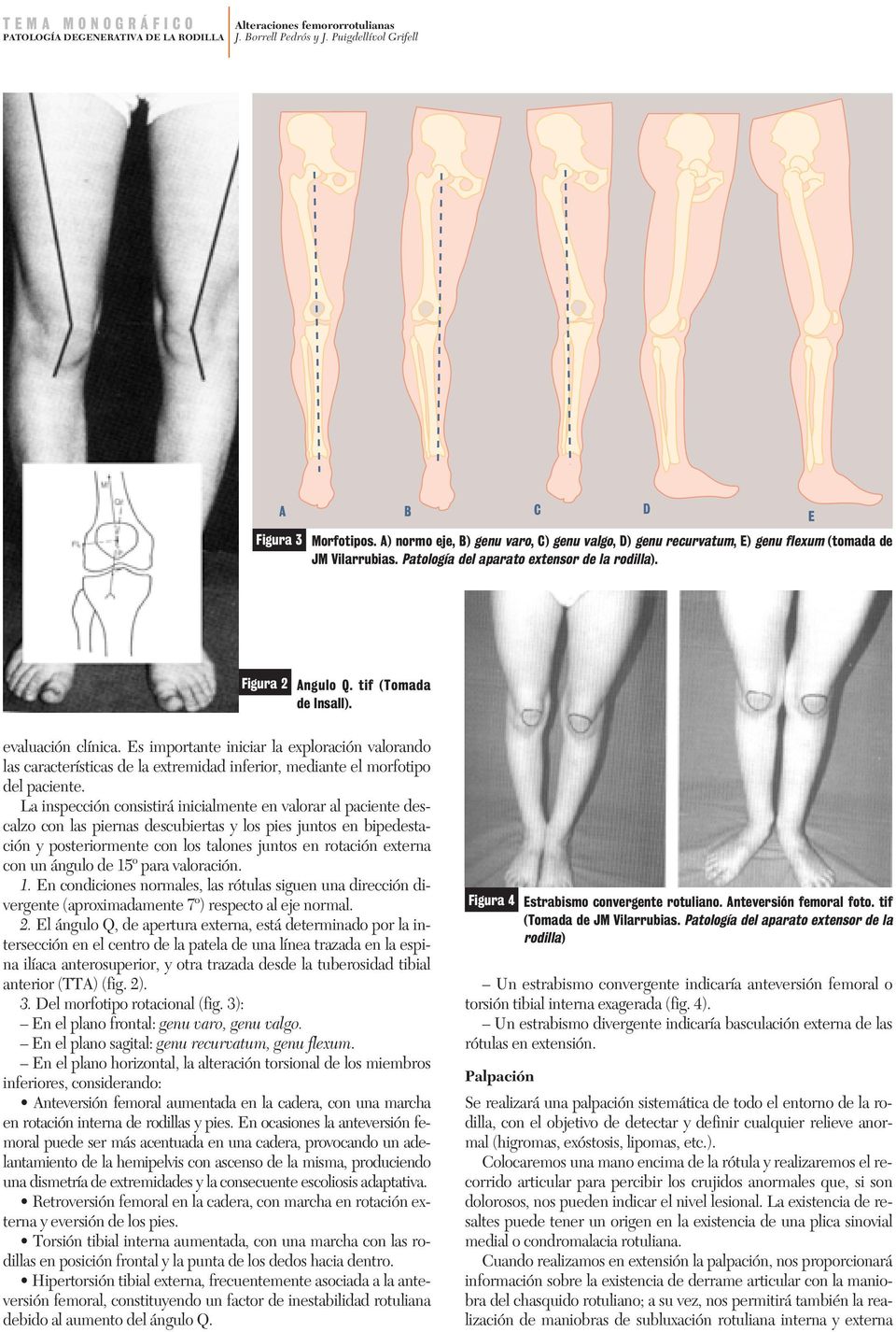 La inspección consistirá inicialmente en valorar al paciente descalzo con las piernas descubiertas y los pies juntos en bipedestación y posteriormente con los talones juntos en rotación externa con