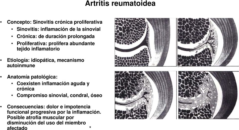 autoinmune Anatomía patológica: Coexisten inflamación aguda y crónica Compromiso sinovial, condral, óseo