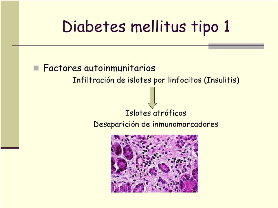 islotes por linfocitos (Insulitis)