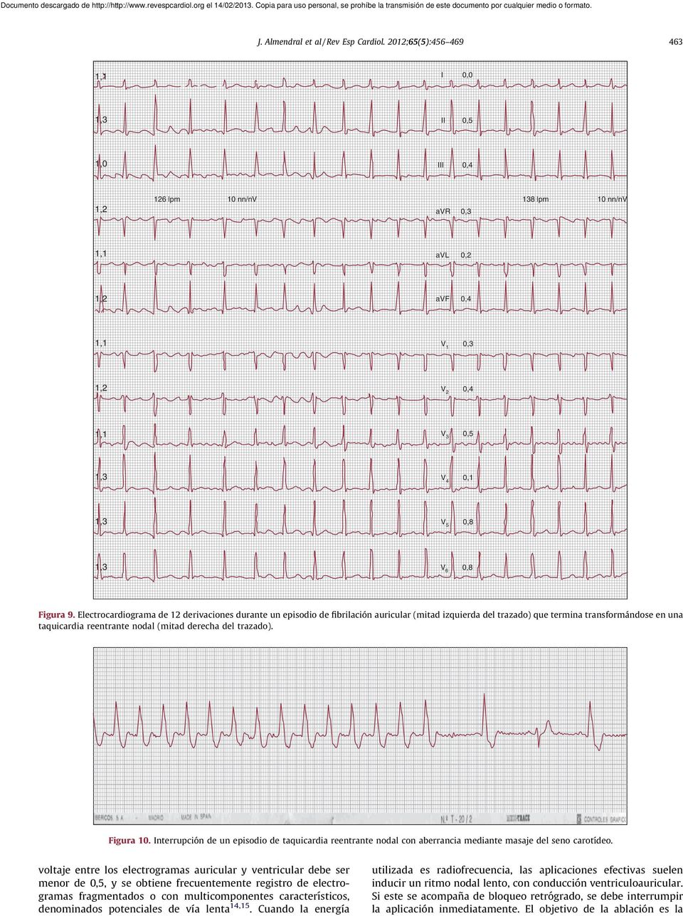 Electrocardiograma de 12 derivaciones durante un episodio de fibrilación auricular (mitad izquierda del trazado) que termina transformándose en una taquicardia reentrante nodal (mitad derecha del
