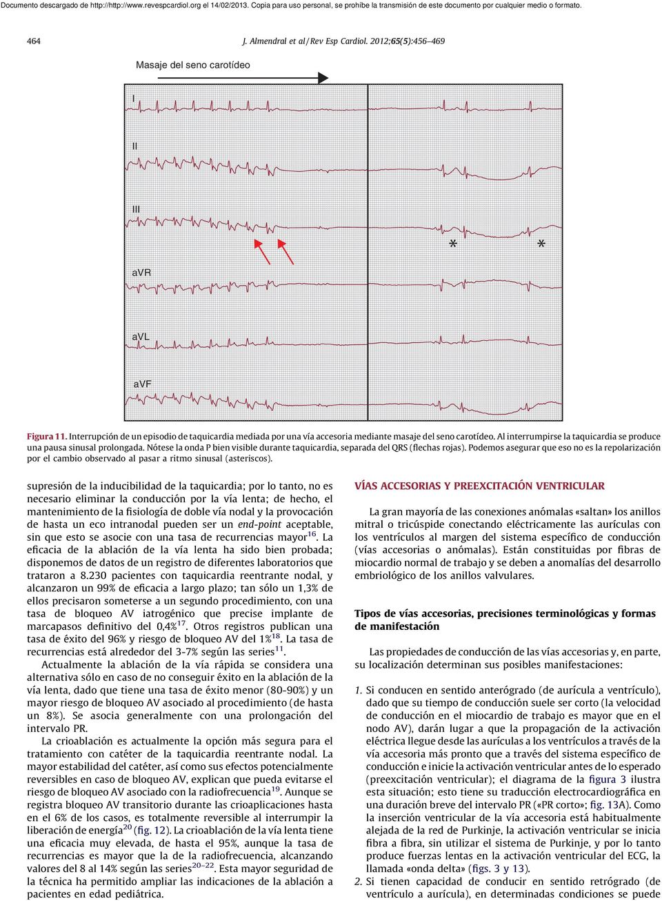 Nótese la onda P bien visible durante taquicardia, separada del QRS (flechas rojas). Podemos asegurar que eso no es la repolarización por el cambio observado al pasar a ritmo sinusal (asteriscos).