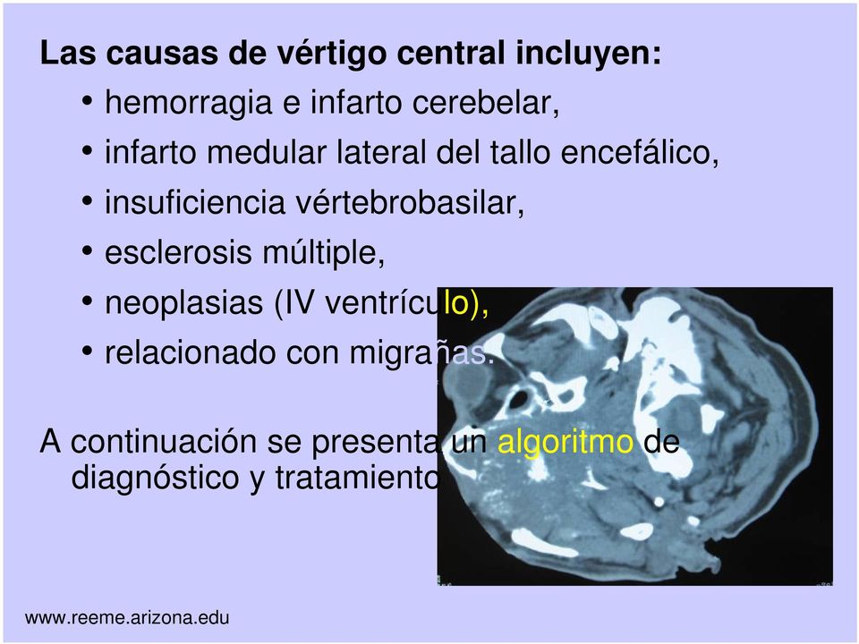 vértebrobasilar, esclerosis múltiple, neoplasias (IV ventrículo),