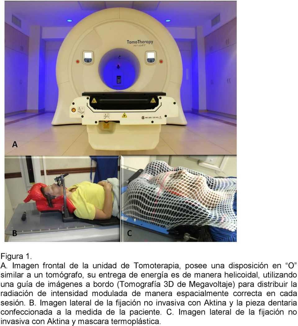 helicoidal, utilizando una guía de imágenes a bordo (Tomografía 3D de Megavoltaje) para distribuir la radiación de intensidad