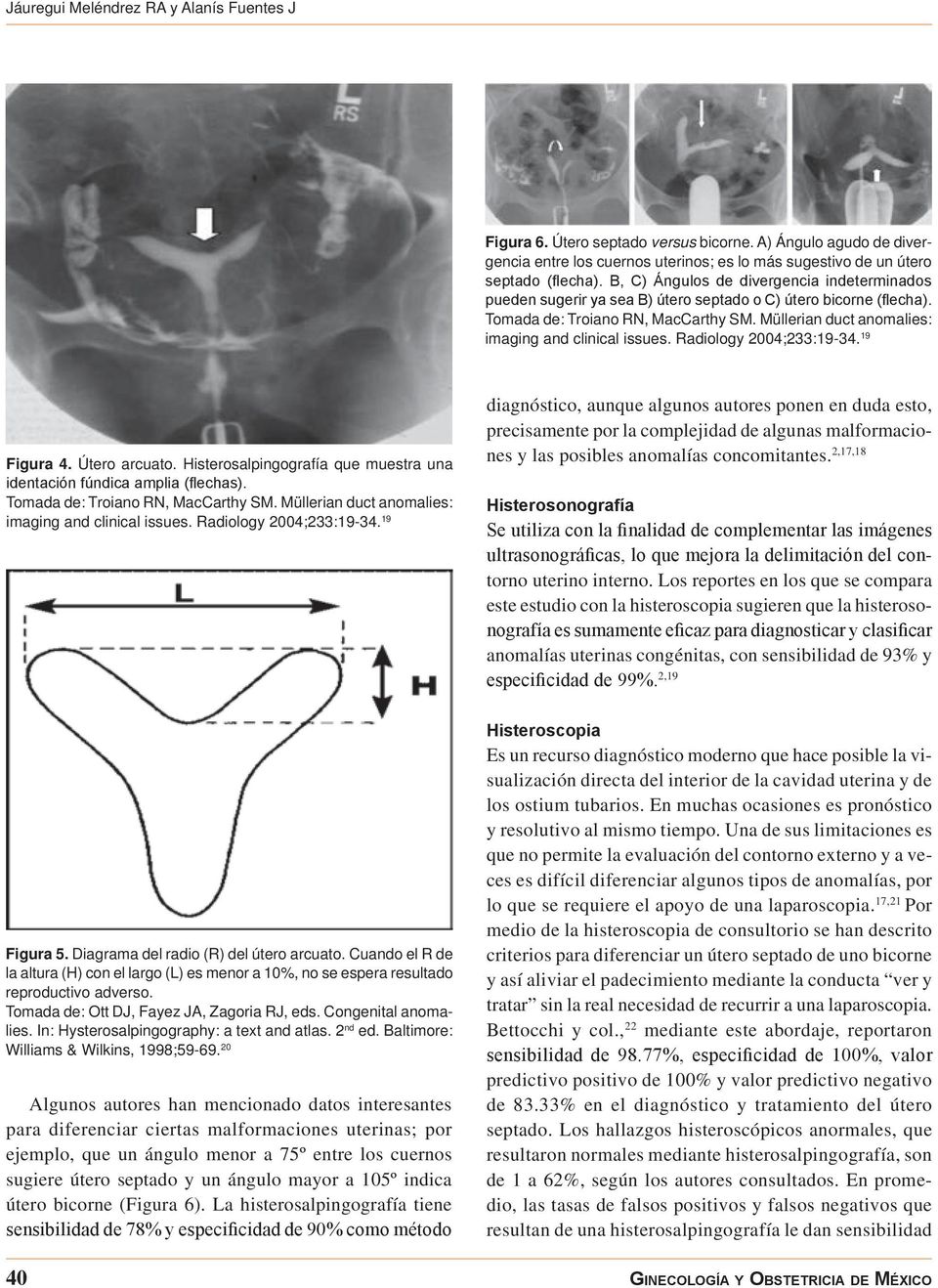 Müllerian duct anomalies: imaging and clinical issues. Radiology 2004;233:19-34. 19 Figura 4. Útero arcuato. Histerosalpingografía que muestra una identación fúndica amplia (flechas).