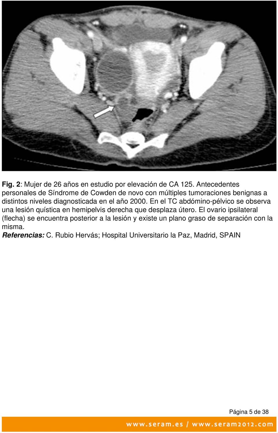 el año 2000. En el TC abdómino-pélvico se observa una lesión quística en hemipelvis derecha que desplaza útero.