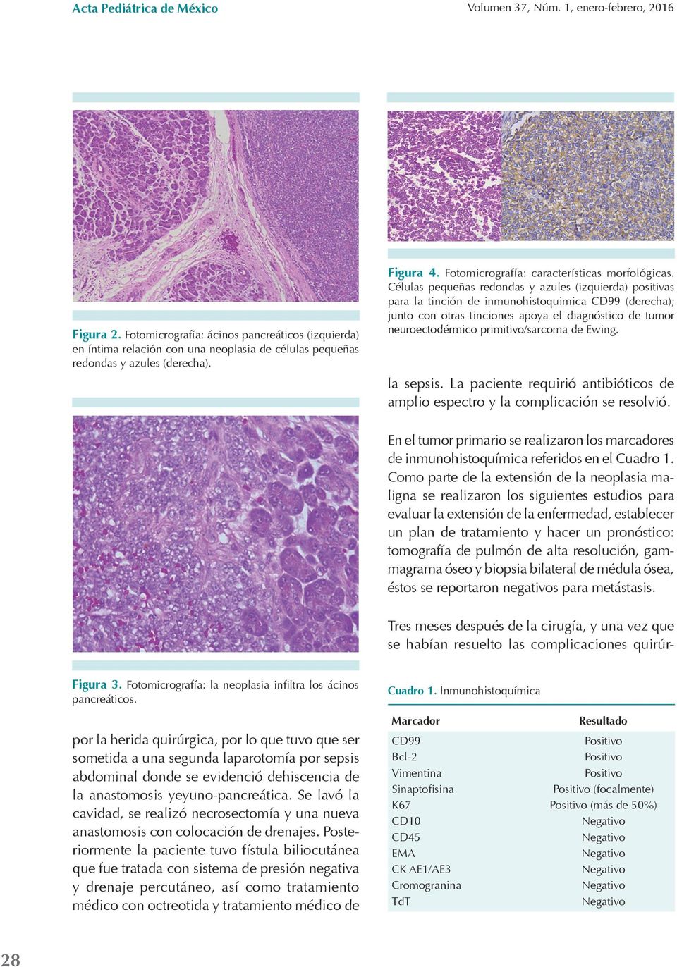 diagnóstico de tumor neuroectodérmico primitivo/sarcoma de Ewing. en íntima relación con una neoplasia de células pequeñas redondas y azules (derecha). la sepsis.