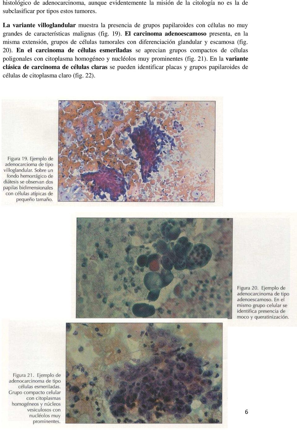 El carcinoma adenoescamoso presenta, en la misma extensión, grupos de células tumorales con diferenciación glandular y escamosa (fig. 20).