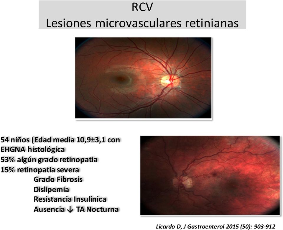 retinopatia severa Grado Fibrosis Dislipemia Resistancia