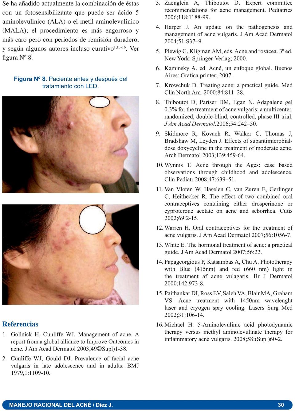 Gollnick H, Cunliffe WJ. Management of acne. A report from a global alliance to Improve Outcomes in acne. J Am Acad Dermatol 2003;49 Supl)1-38. 2. Cunliffe WJ, Gould DJ.