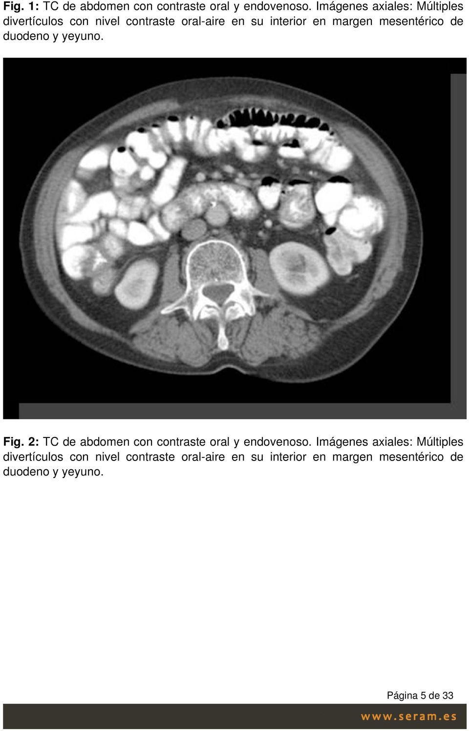 mesentérico de duodeno y yeyuno. Fig. 2: TC de abdomen con contraste oral y endovenoso.