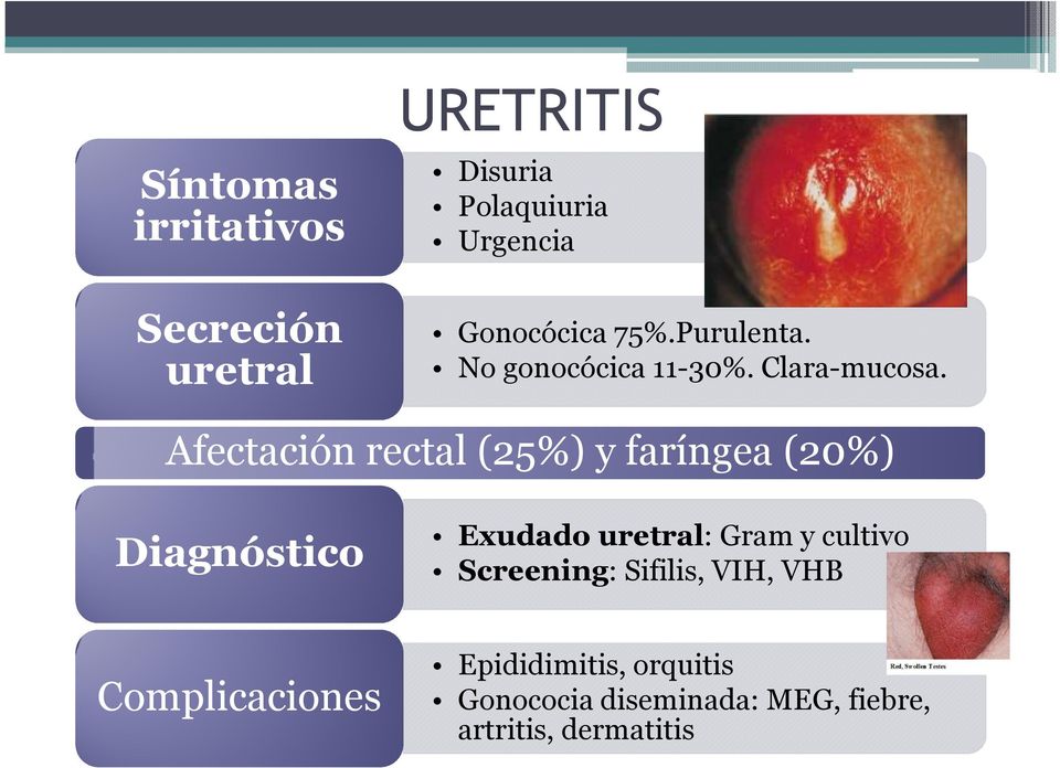 Afectación rectal (25%) y faríngea (20%) Diagnóstico Exudado uretral: Gram y cultivo