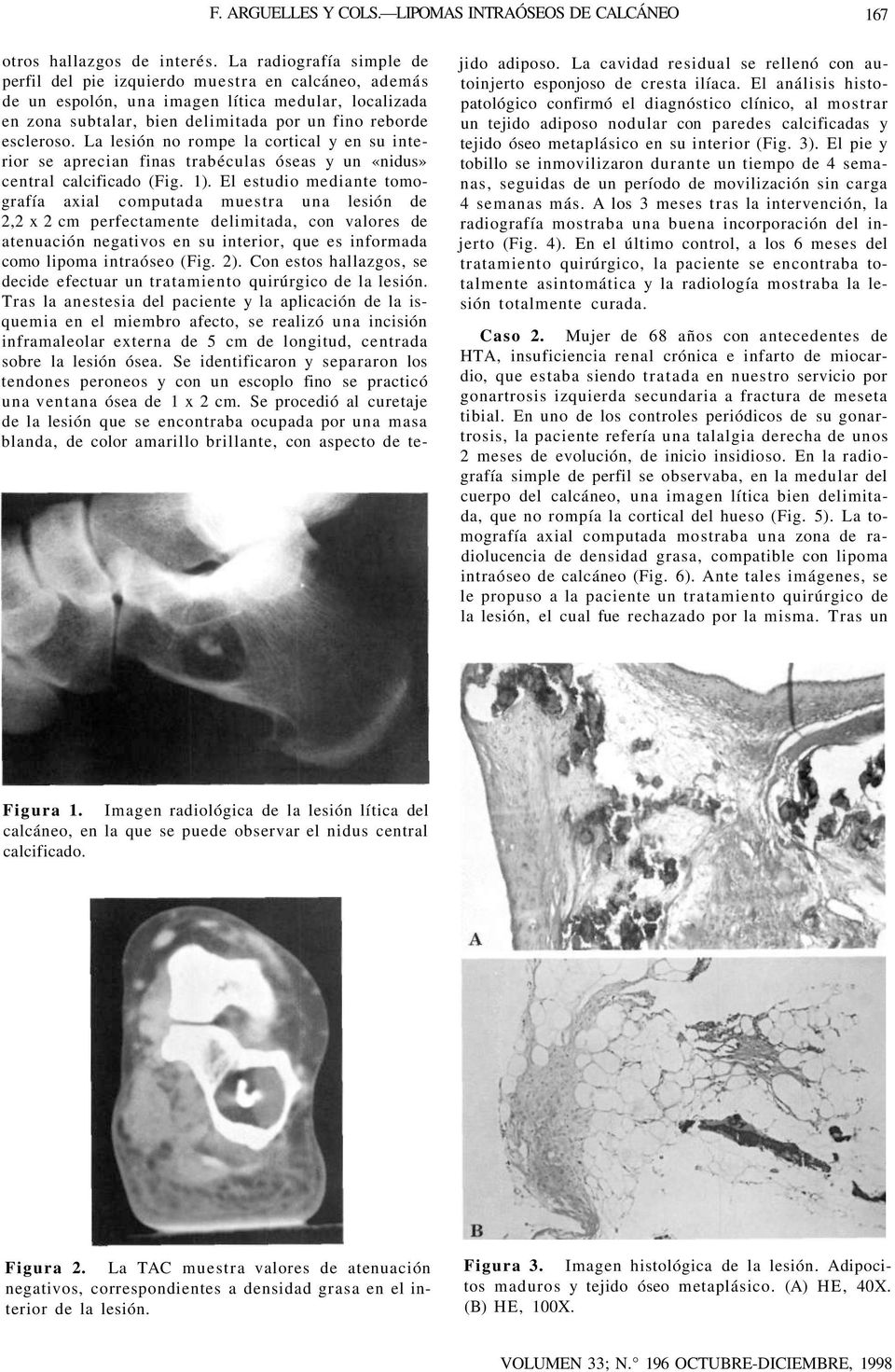 La lesión no rompe la cortical y en su interior se aprecian finas trabéculas óseas y un «nidus» central calcificado (Fig. 1).