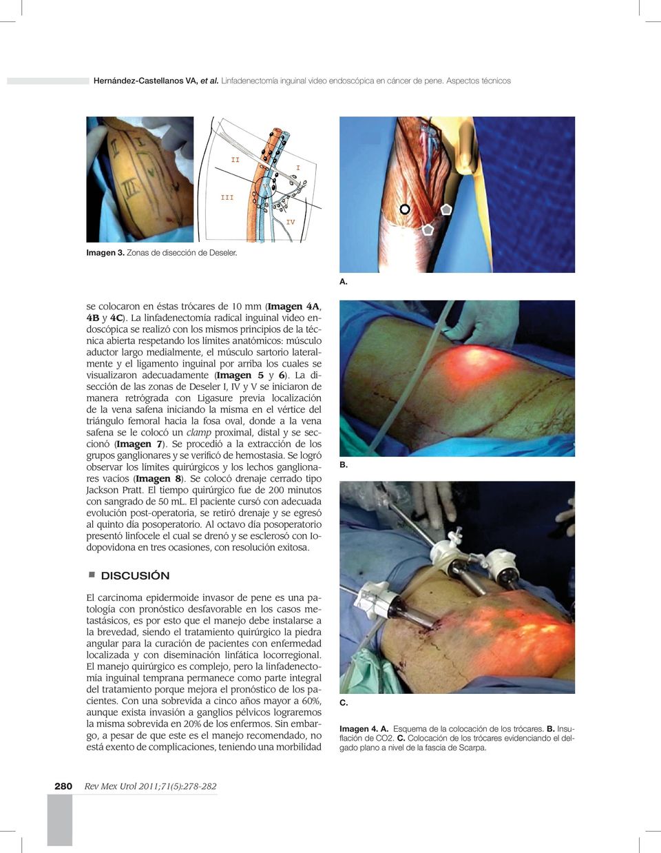 sartorio lateralmente y el ligamento inguinal por arriba los cuales se visualizaron adecuadamente (Imagen 5 y 6).