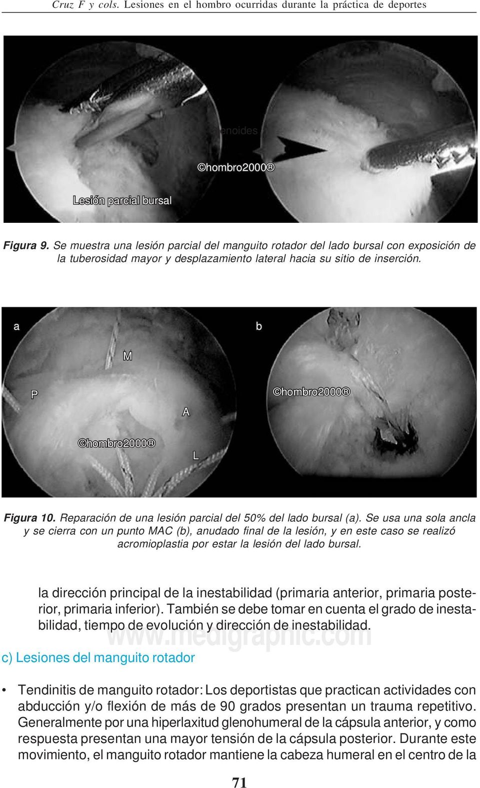 a b M P A hombro2000 hombro2000 L Figura 10. Reparación de una lesión parcial del 50% del lado bursal (a).
