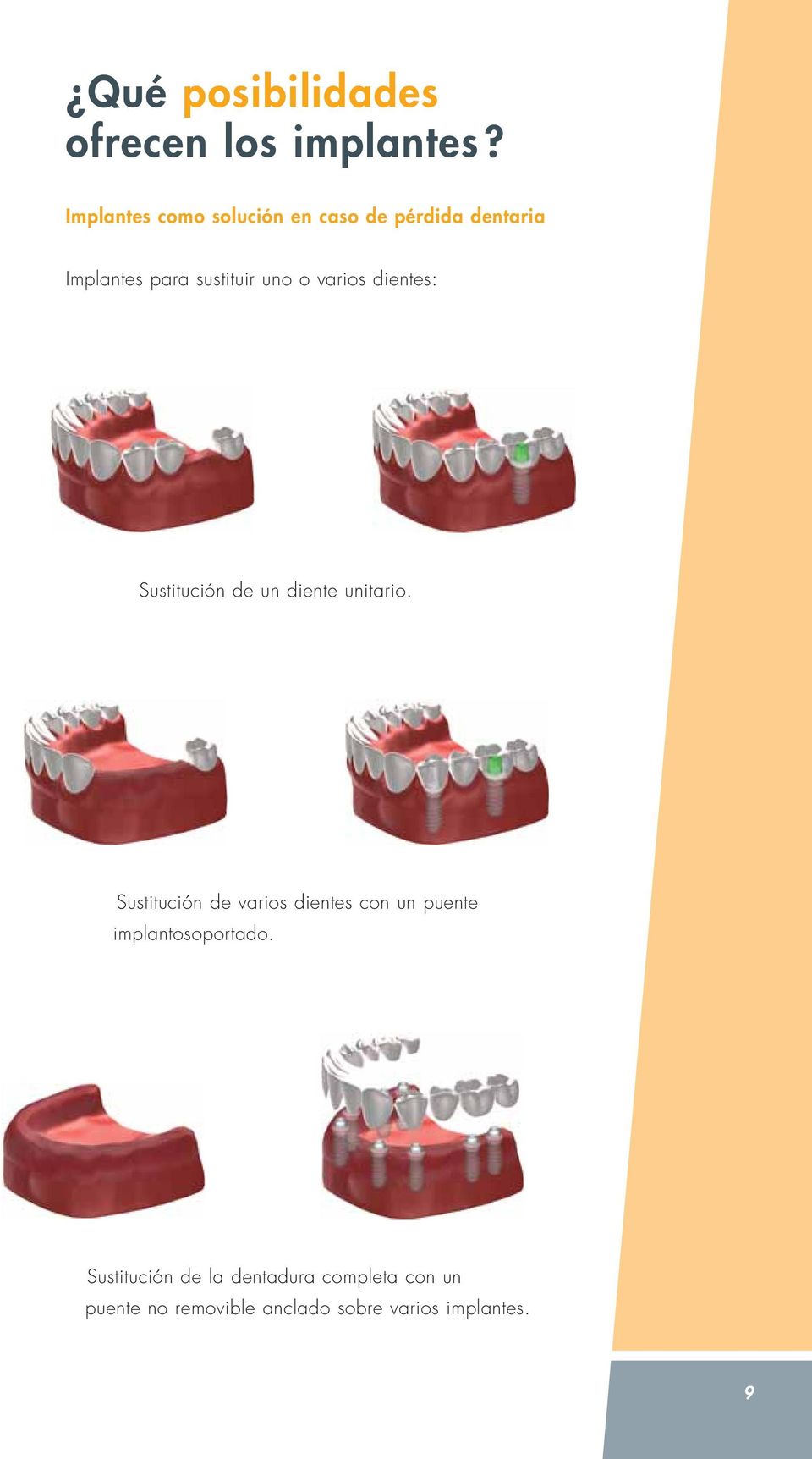 varios dientes: Sustitución de un diente unitario.