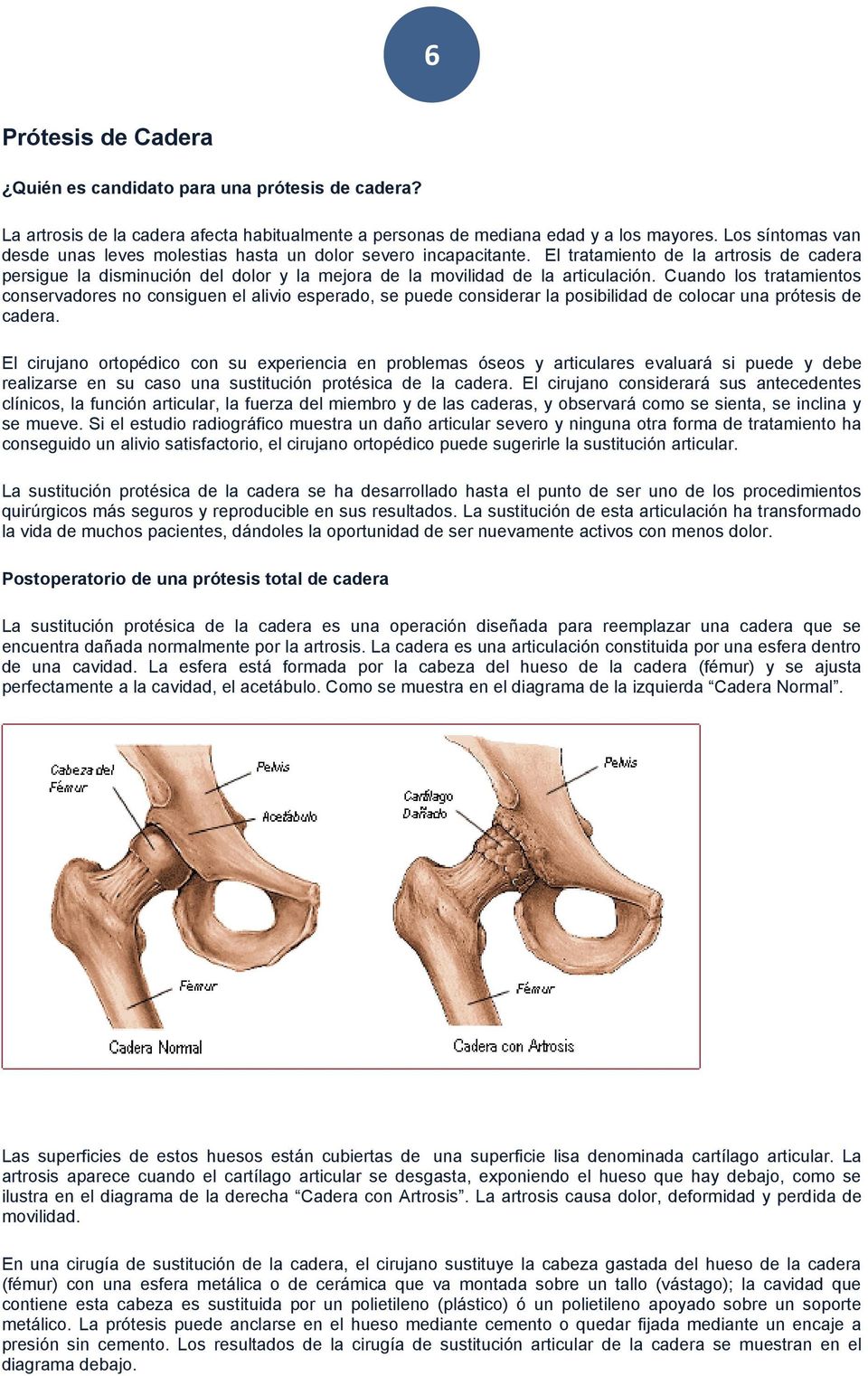 El tratamiento de la artrosis de cadera persigue la disminución del dolor y la mejora de la movilidad de la articulación.