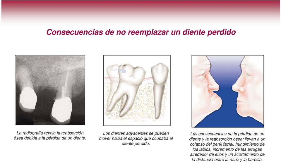 Las consecuencias de la pérdida de un diente y la reabsorción ósea: llevan a un colapso del perfil facial,