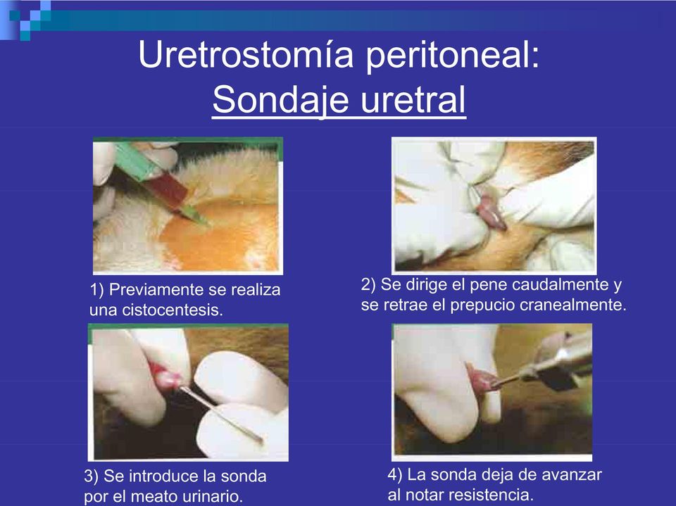 Uretrostomía peritoneal: Sondaje uretral 1) Previamente se