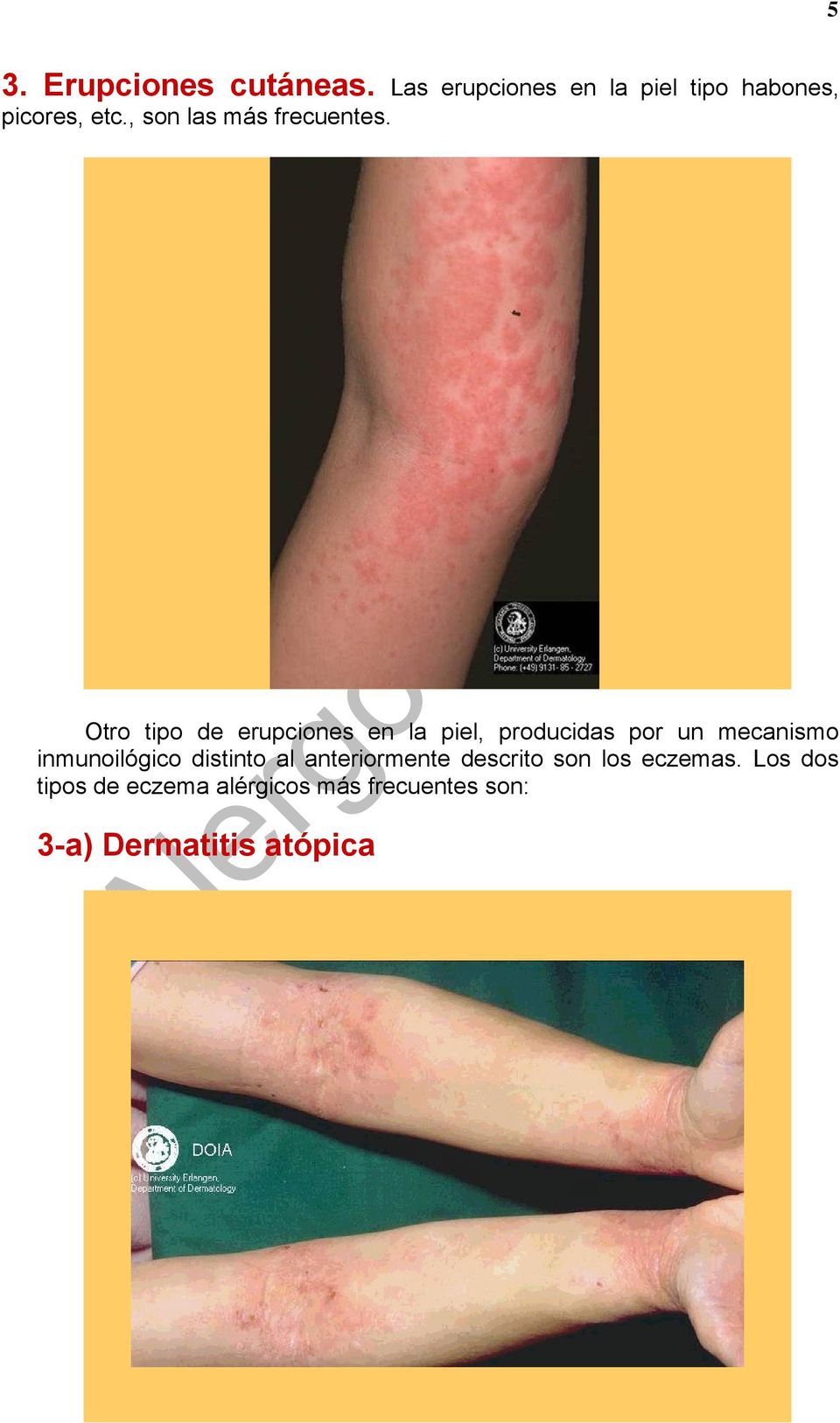 Otro tipo de erupciones en la piel, producidas por un mecanismo inmunoilógico