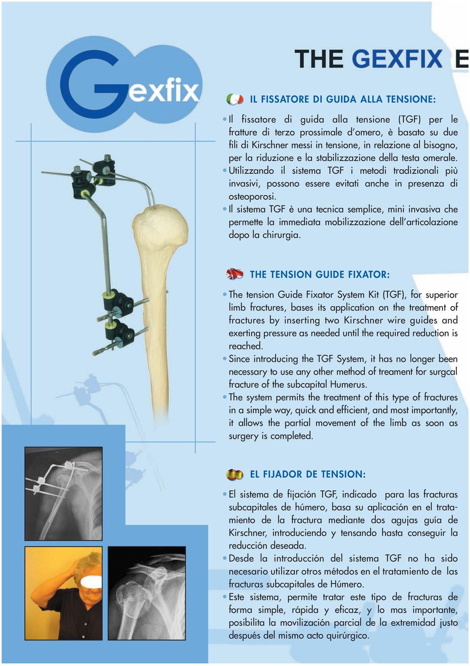 Il sistema TGF è una tecnica semplice, mini invasiva che permette la immediata mobilizzazione dell articolazione dopo la chirurgia.