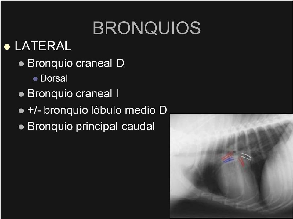 BRONQUIOS +/- bronquio