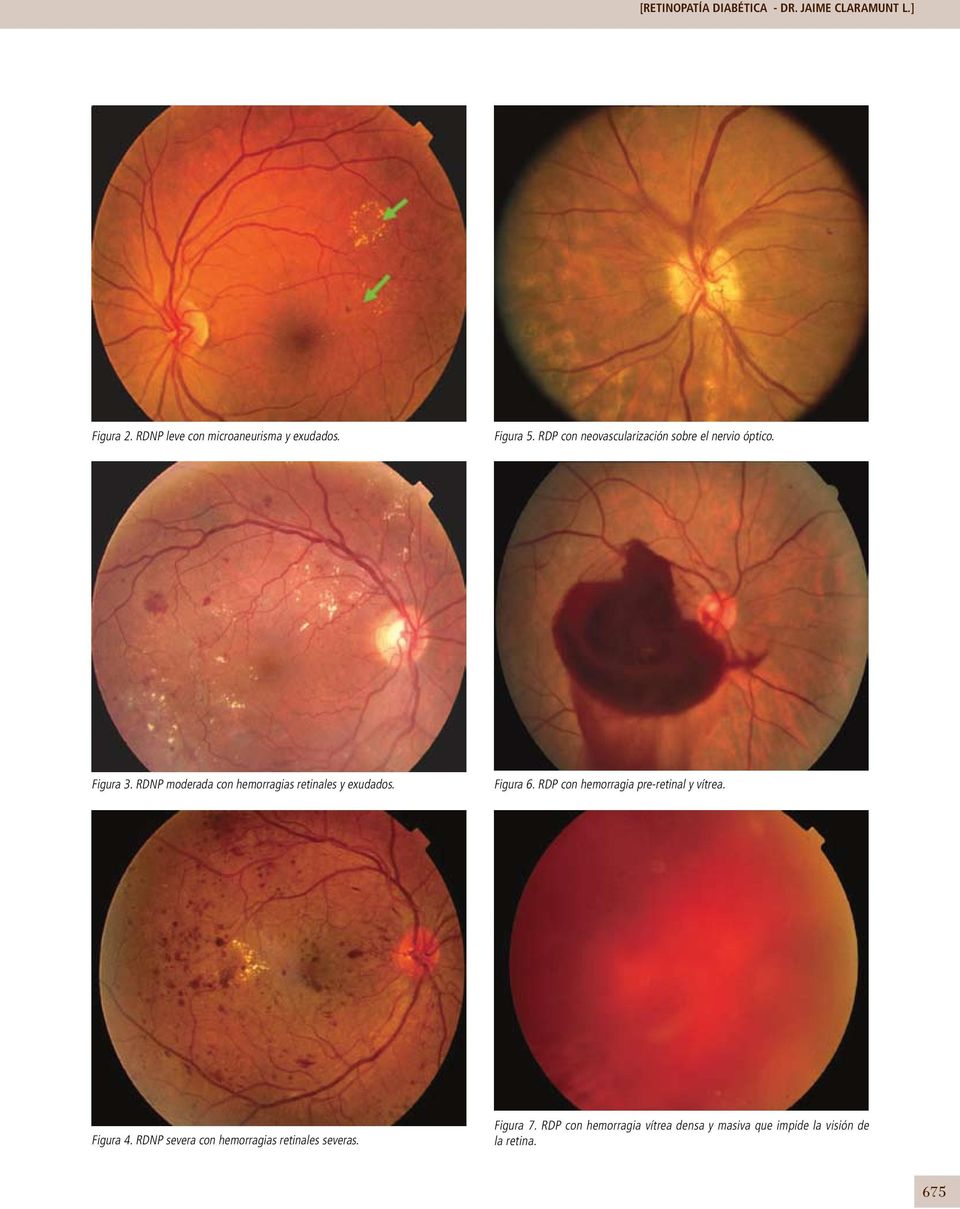 RDNP moderada con hemorragias retinales y exudados. Figura 6. RDP con hemorragia pre-retinal y vítrea.