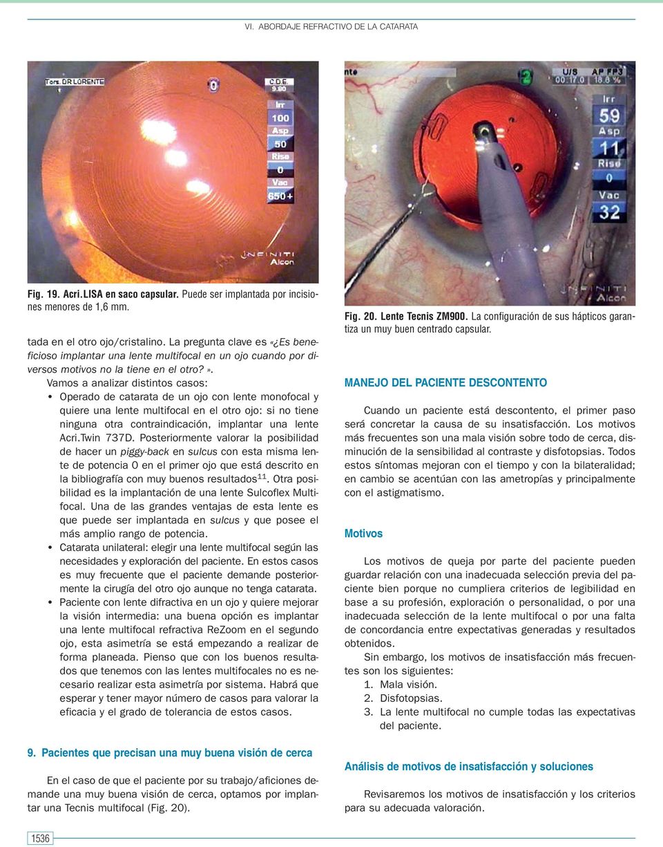 Vamos a analizar distintos casos: Operado de catarata de un ojo con lente monofocal y quiere una lente multifocal en el otro ojo: si no tiene ninguna otra contraindicación, implantar una lente Acri.
