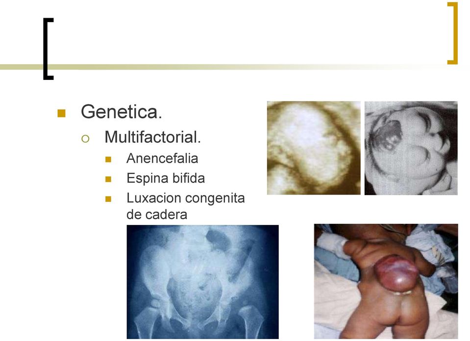 Anencefalia Espina