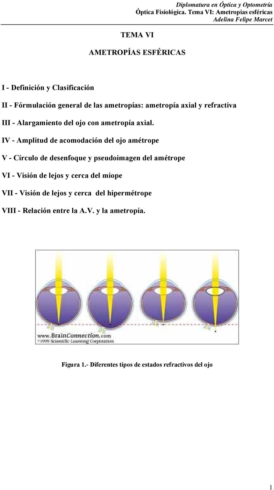 ametroías: ametroía axial y refractiva III - Alargamiento del ojo con ametroía axial.