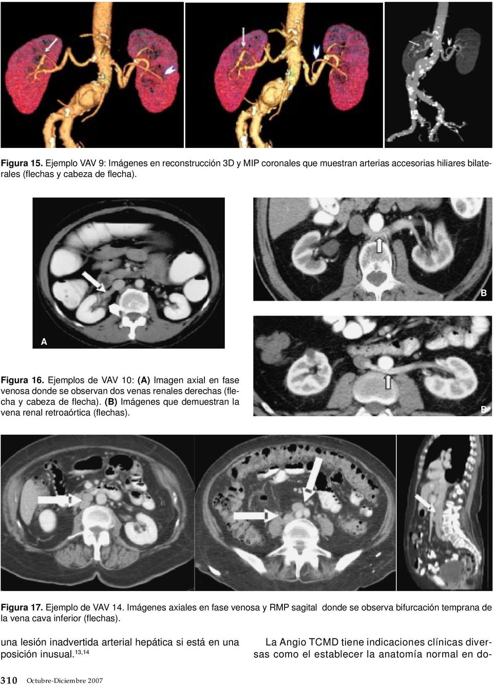 (B) Imágenes que demuestran la vena renal retroaórtica (flechas). B Figura 17. Ejemplo de VAV 14.