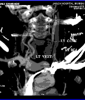 Takayasu: #1 arteritis pediatrica de grandes vasos: la pesadilla del