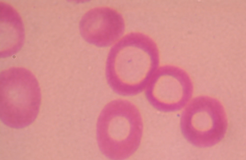 HEMOGLOBINA CORPUSCULAR MEDIA (VCM) Es la cantidad promedio de Hb en cada eritrocito.