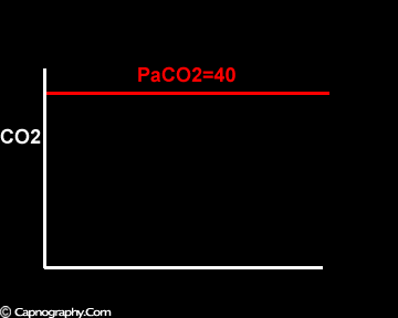 EtCO2: Capnografía Gradiente PaCO2-EtCO2 Valor de monitorización más útil de la capnografía.