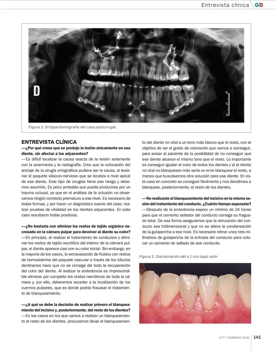 Creo que la colocación del anclaje de la cirugía ortognática pudiera ser la causa, al lesionar el paquete vásculo-nervioso que se localiza a nivel apical de ese diente.