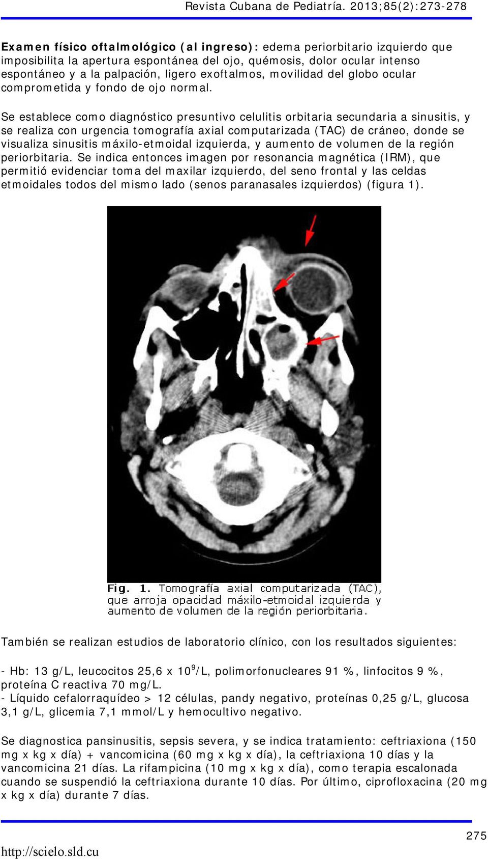 Se establece como diagnóstico presuntivo celulitis orbitaria secundaria a sinusitis, y se realiza con urgencia tomografía axial computarizada (TAC) de cráneo, donde se visualiza sinusitis